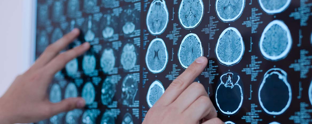 بیماری مالتیپل اسکلروزیس؛ صفر تا صد علائم، تشخیص و درمان